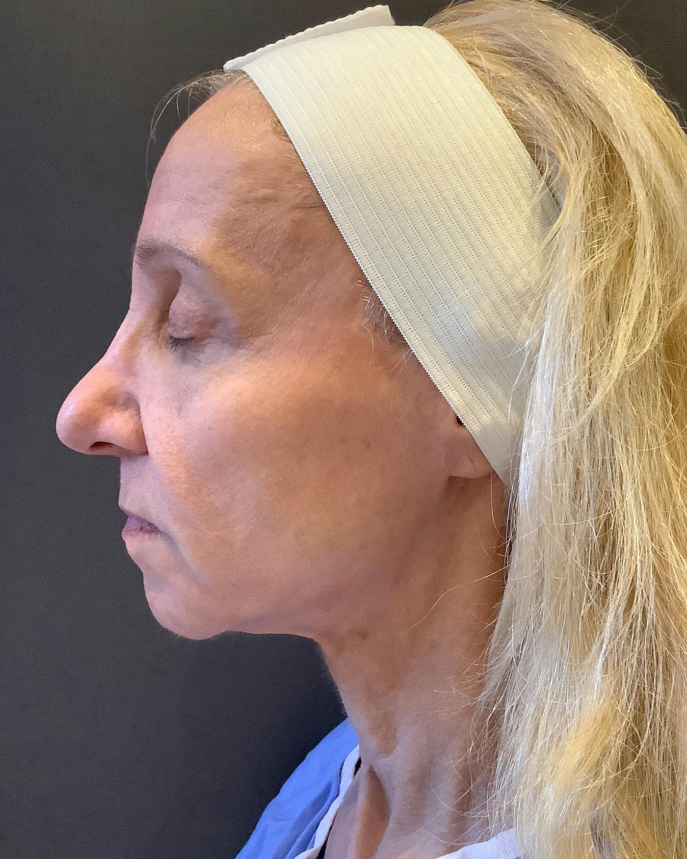 Facelifts / Necklift Before & After Gallery - Patient 506655 - Image 7