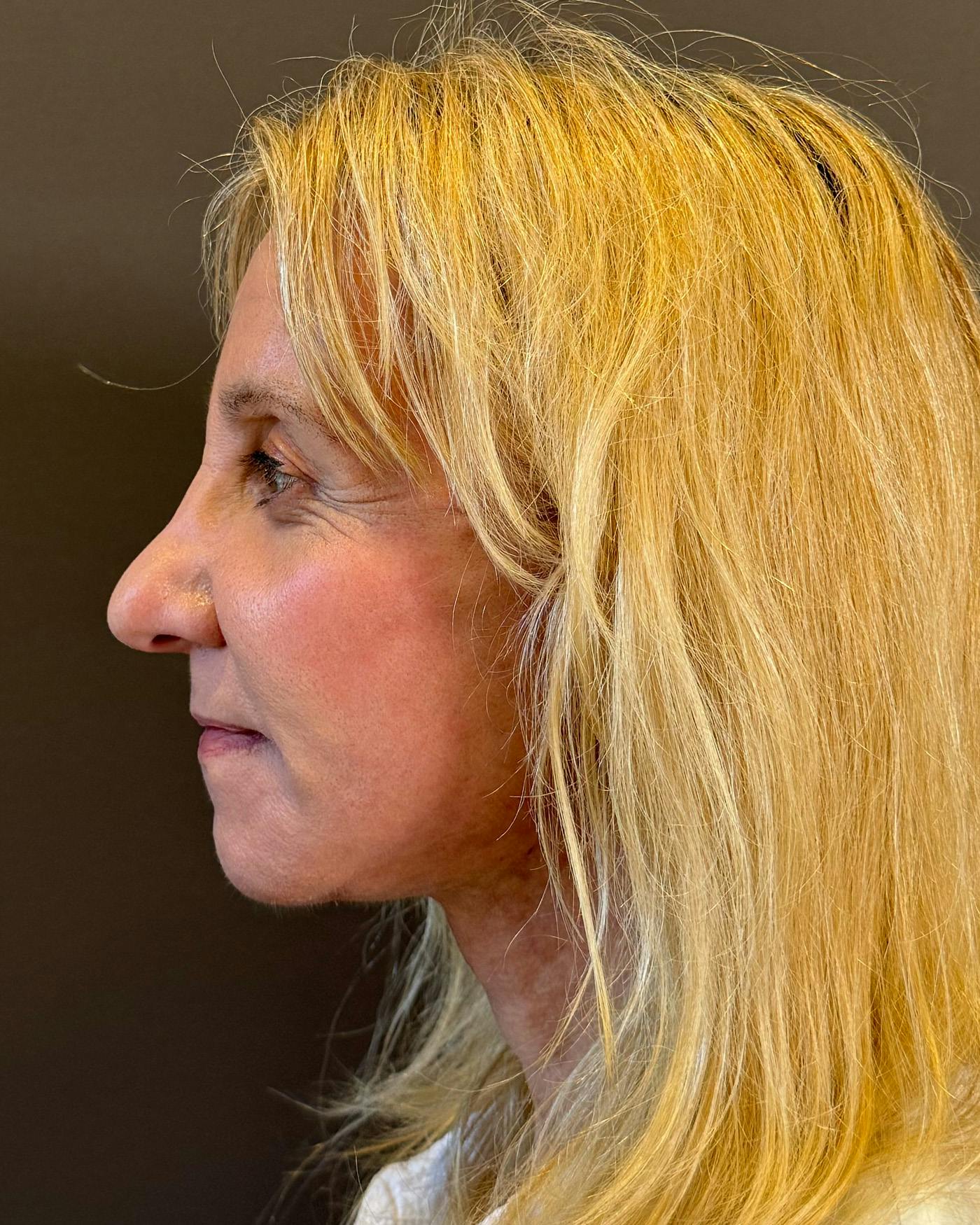 Facelifts / Necklift Before & After Gallery - Patient 506655 - Image 8