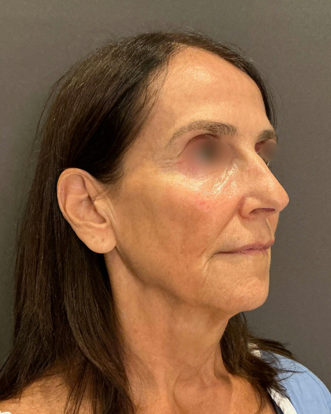 Facelifts / Necklift Before & After Gallery - Patient 780352 - Image 1