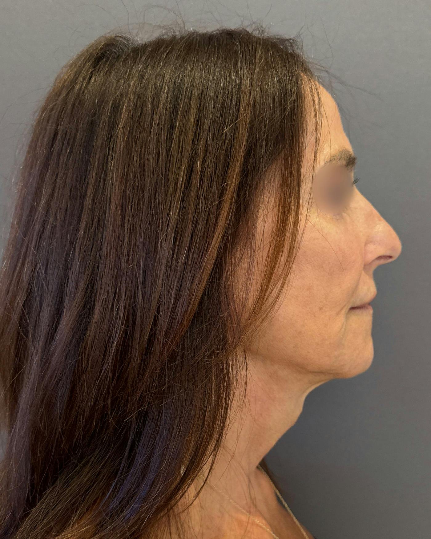 Facelifts / Necklift Before & After Gallery - Patient 780352 - Image 4