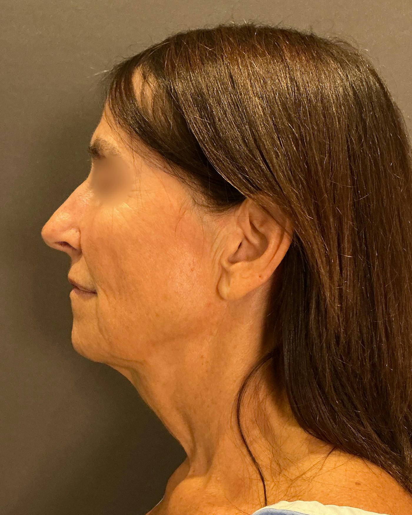 Facelifts / Necklift Before & After Gallery - Patient 780352 - Image 7