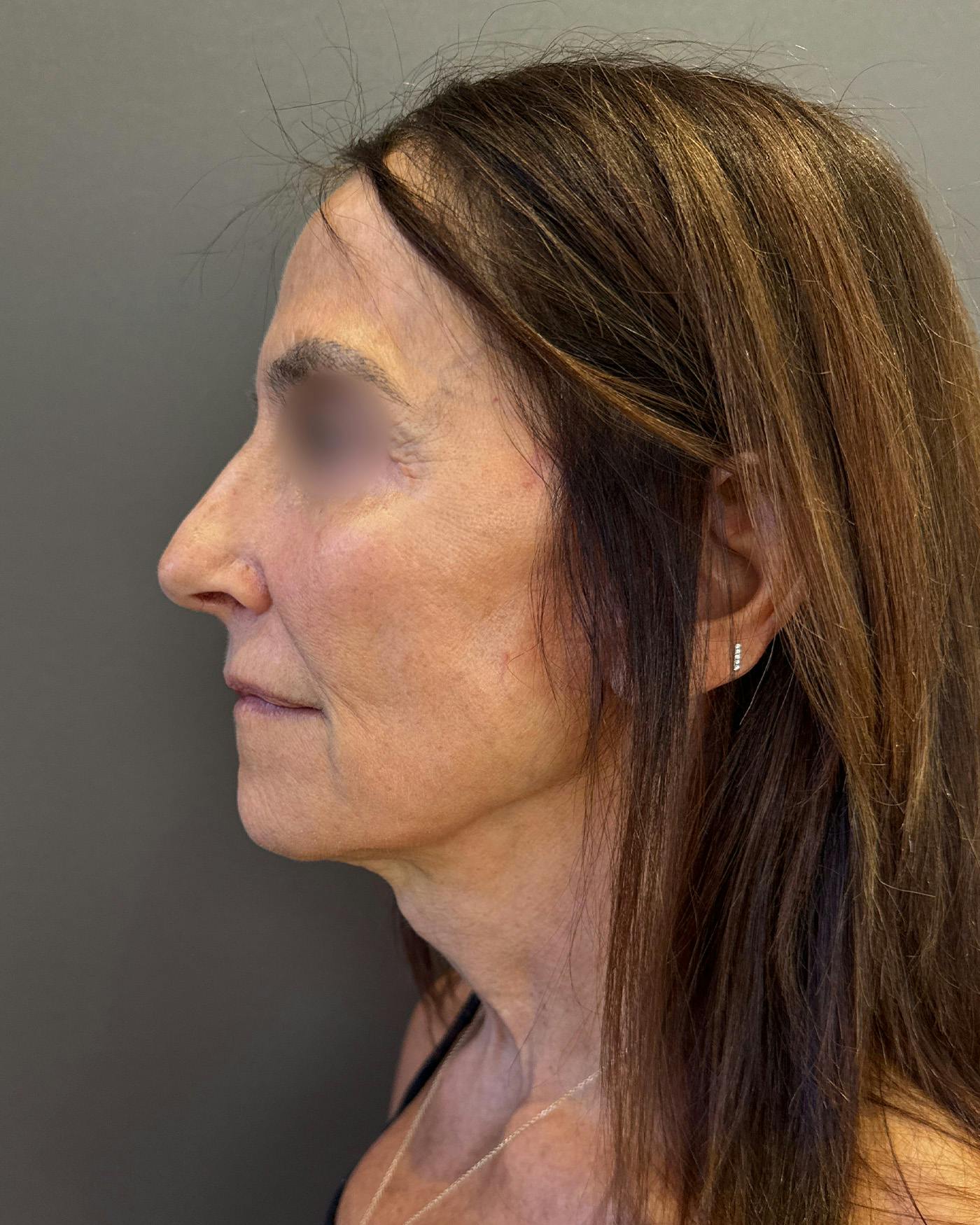 Facelifts / Necklift Before & After Gallery - Patient 780352 - Image 8