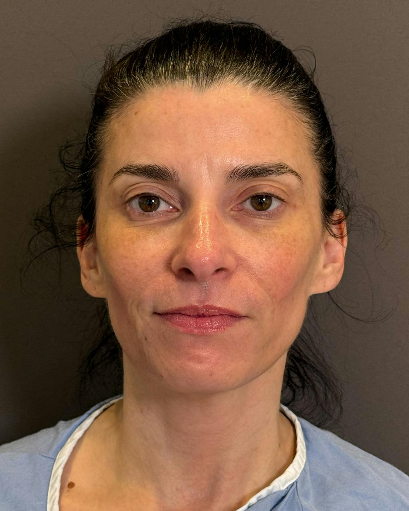 Facelifts / Necklift Before & After Gallery - Patient 371263 - Image 5