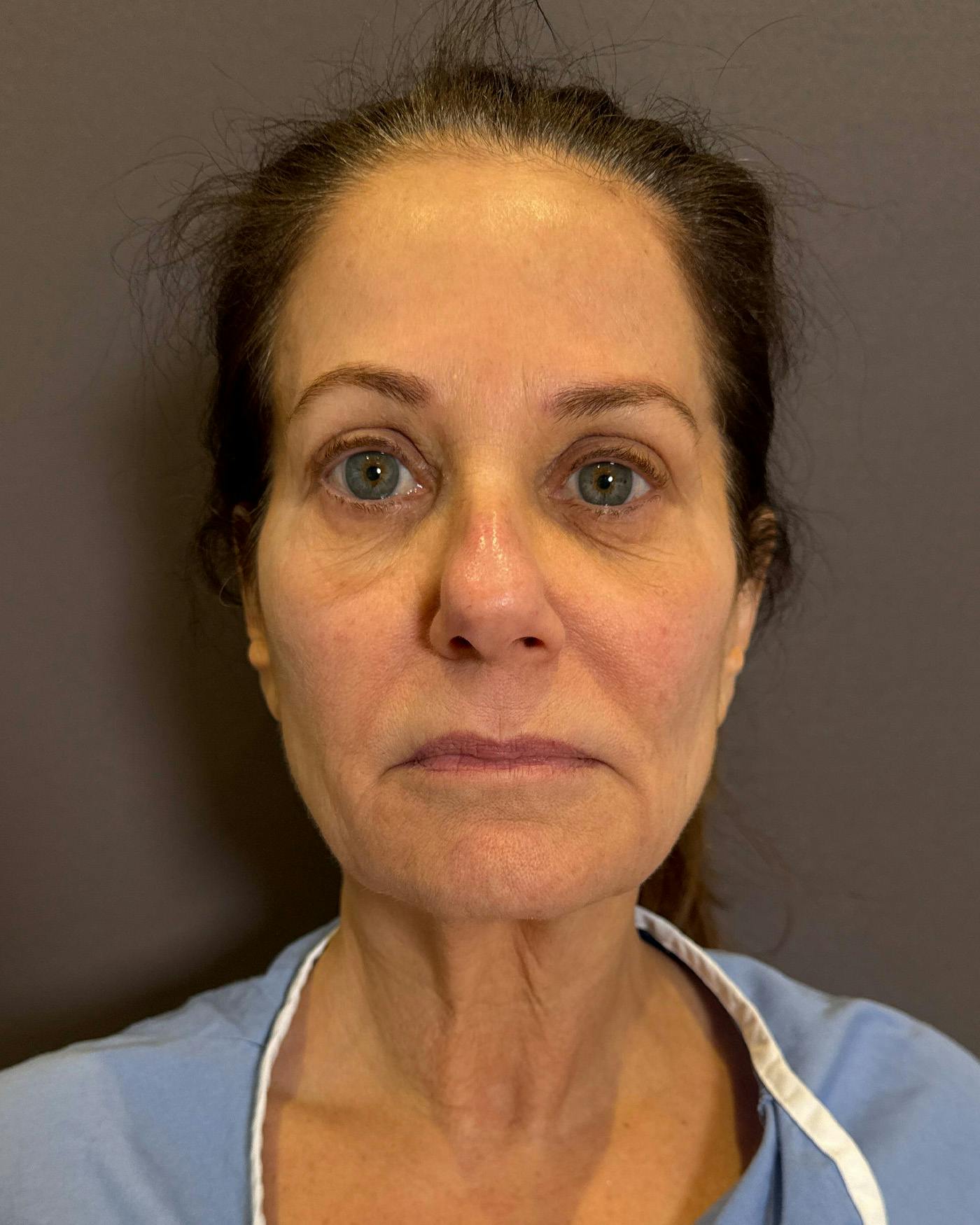 Facelifts / Necklift Before & After Gallery - Patient 507654 - Image 3