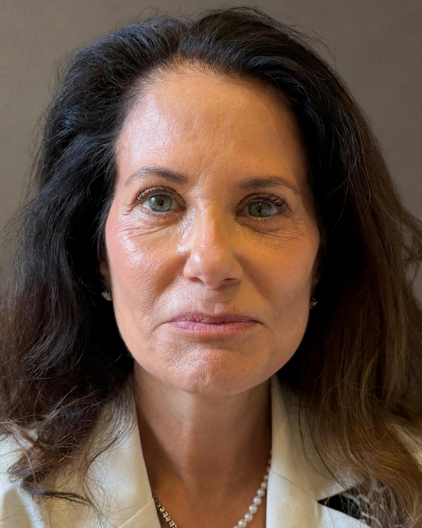Facelifts / Necklift Before & After Gallery - Patient 507654 - Image 4