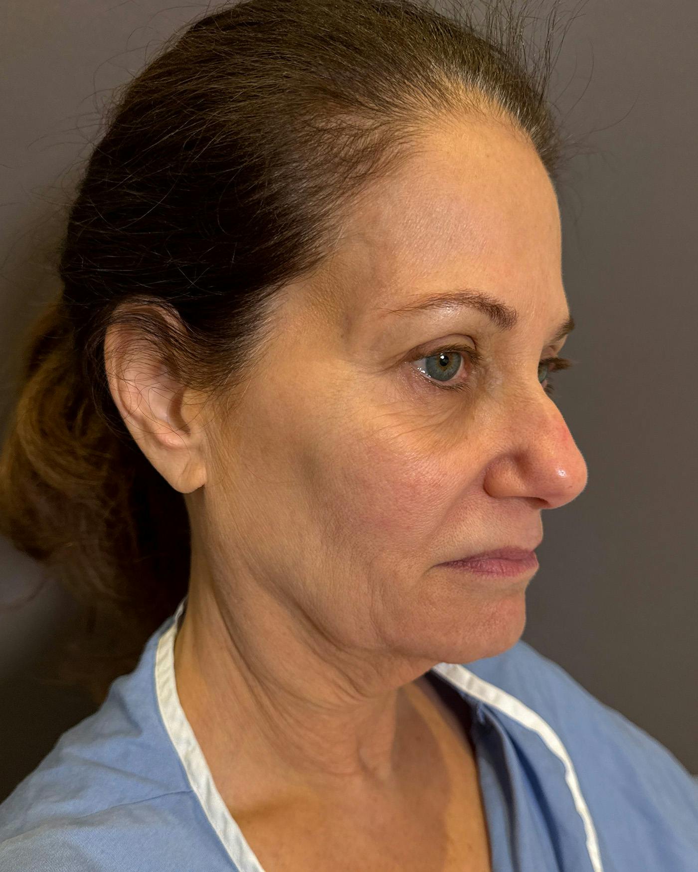 Facelifts / Necklift Before & After Gallery - Patient 507654 - Image 1