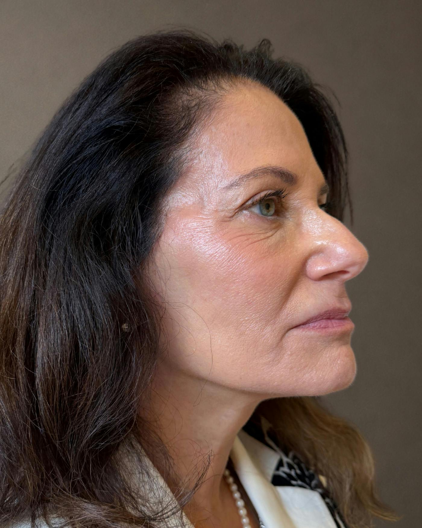 Facelifts / Necklift Before & After Gallery - Patient 507654 - Image 2