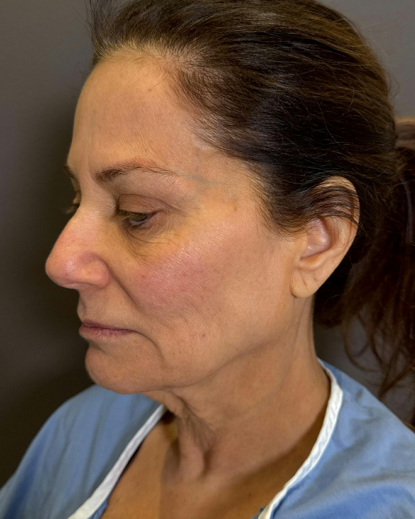 Facelifts / Necklift Before & After Gallery - Patient 507654 - Image 5