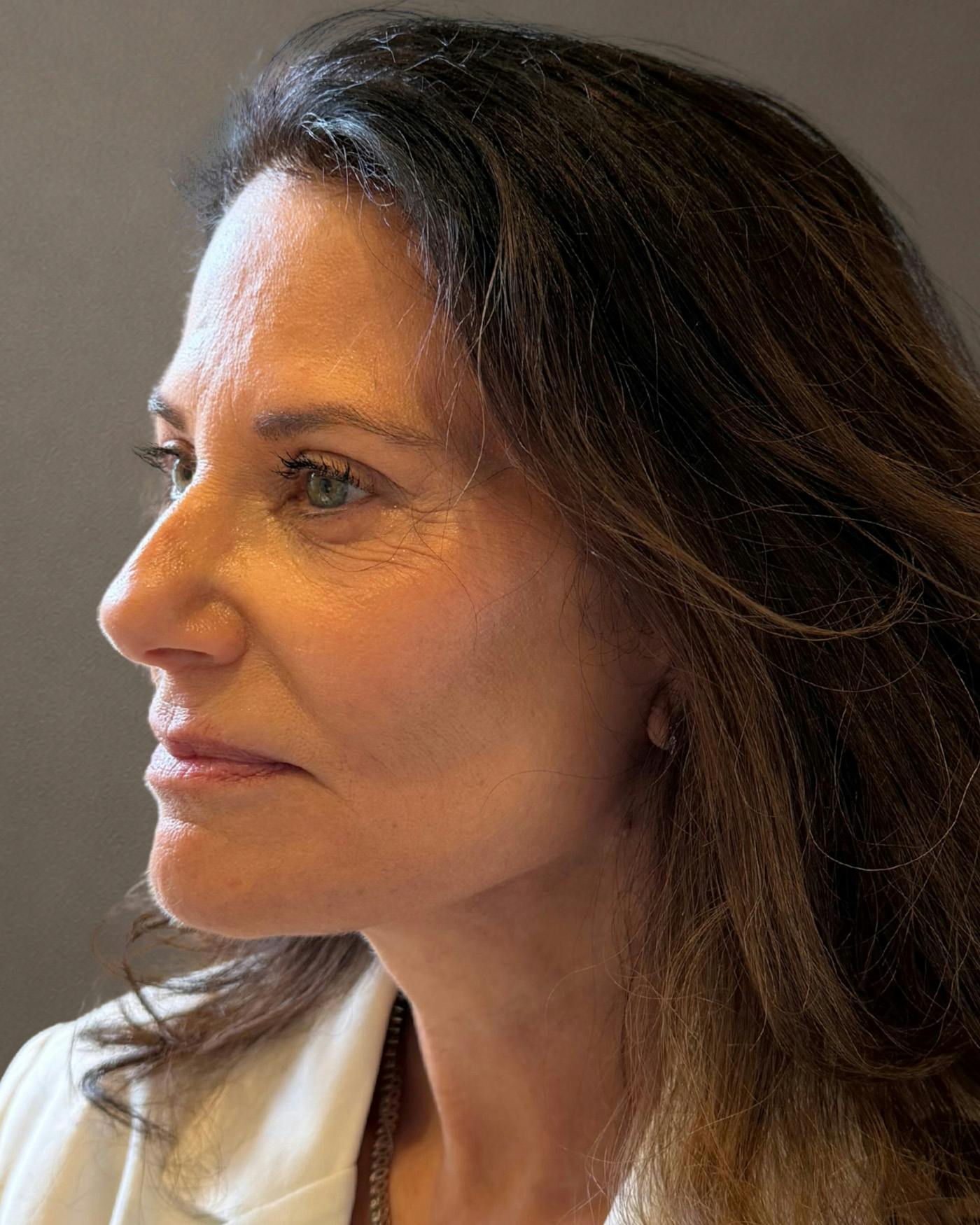 Facelifts / Necklift Before & After Gallery - Patient 507654 - Image 6